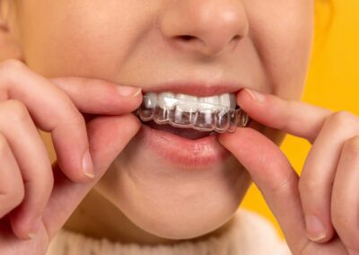 Getting Invisalign® After Braces