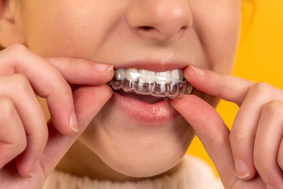 How Long Do Braces Take To Straighten Teeth? - Mill Creek Orthodontics
