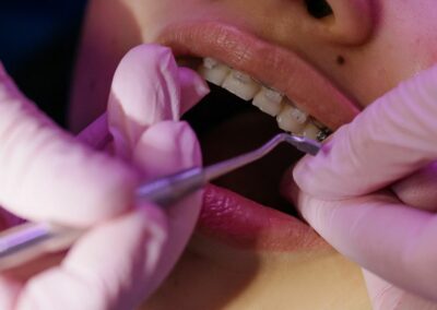 Can Braces Harm Your Teeth?