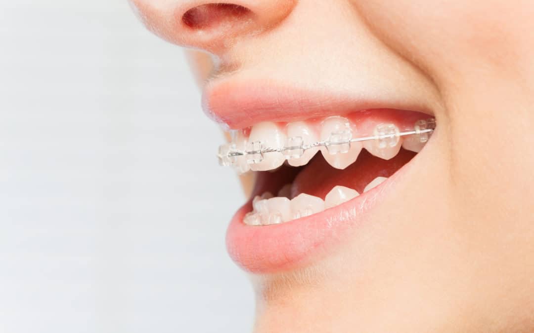 What to Consider When Getting Braces as an Adult