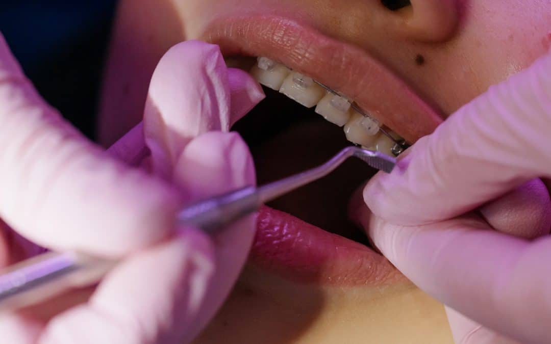 What Is Dental Wax?