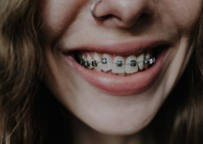 Do Wisdom Teeth Affect Braces?