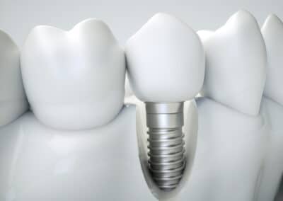 Clearing the Air: Debunking Common Myths About Dental Implants and Their Benefits