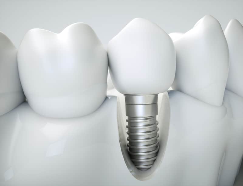Clearing the Air: Debunking Common Myths About Dental Implants and Their Benefits